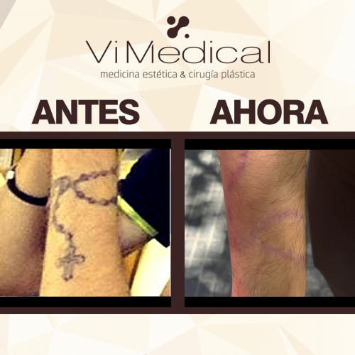 Eliminaci�n Tatuajes